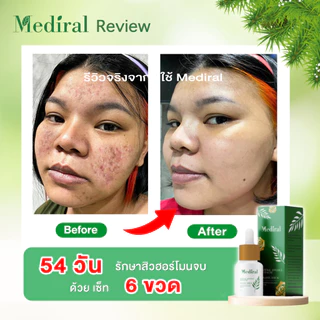 (ส่งฟรี)เมดิรอล เซรั่มลดสิวMediral ตัดวงจรสิวซ้ำซาก ฆ่าเชื้อสิวใน7วันดีขึ้น ผิวแข็งแรง ออร์แกนิก