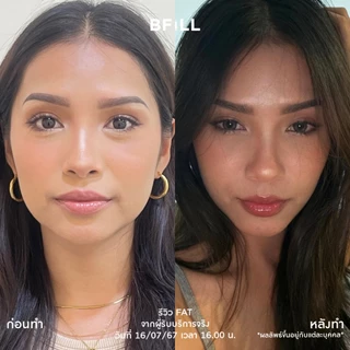 BFiLL โปรแกรม Fat ฉีดแฟต ลดไขมัน ลดแก้ม ลดเหนียง ปรับรูปหน้า หน้าเรียว กรอบหน้าชัด ลดสัดส่วน ลดไขมันเฉพาะจุด ผิวกระชับ