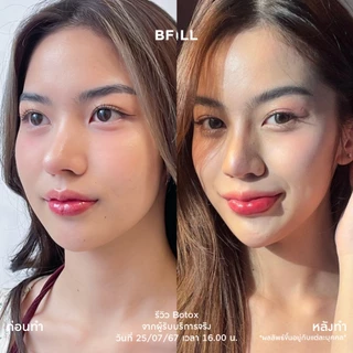BFiLL โปรแกรม Botox Nabota โบท็อกซ์กราม ลดกราม ลิฟท์หน้า กรอบหน้าชัด ปรับรูปหน้าเรียว ออกฤทธิ์เร็ว ดื้อยาน้อย เหมา 100U