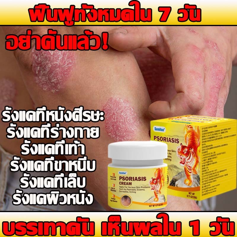 ช่วยบรรเทาอาการคันได้อย่างรวดเร็วเพื่อบรรเทาอาการคันบรรเทาเชื้อรา ที่เท้าขาหนีบร่างกายหัวมือ และพื้น ที่อื่น ๆช่วยลดอากา