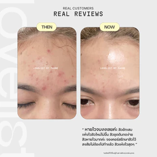 Lovelist เซรั่มเฮิร์บปี้ ฮีลผิวสิวสงบ Herbpy Secret Serum