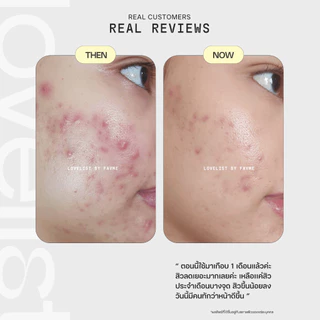 Lovelist เซรั่มเฮิร์บปี้ ฮีลผิวสิวสงบ Herbpy Secret Serum