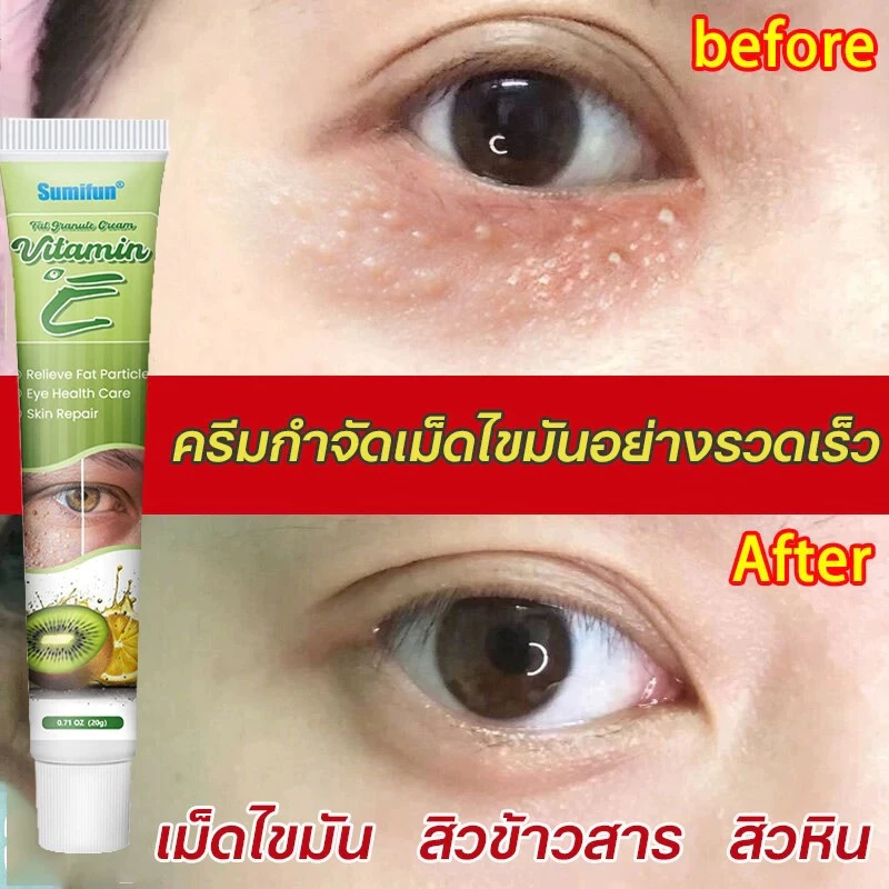 ครีมบำรุงรอบตา ครีมทาตาเม็ดไขมัน อายครีมกำจัดเม็ดไขมัน สิวข้าวสาร สิวหินอย่างมีประสิทธิภาพ กระชับผิว ผิวชุ่มชื้นเนียนนุ่