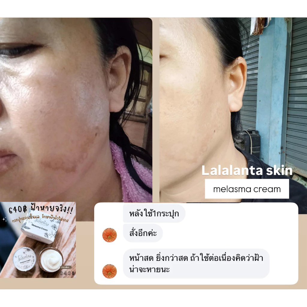 🌈ฝ้าหนาจาง ⚡️⚡️Lalanta Super Melasma Clear ลดฝ้า หน้าขาวใส 🔥