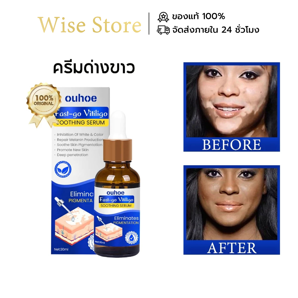 OUHOE ครีมด่างขาว ครีมทาด่างขาว ยาด่างขาว ครีมแก้ด่างขาวอย่างแข็งแกร่ง บรรเทาต่างขาว เม็ดสีสะสมอย่างมีประสิทธิภาพ