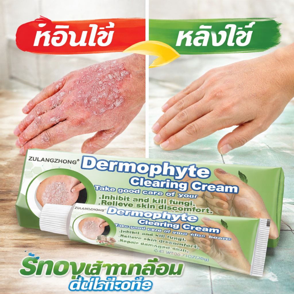 ครีมทาเชื้อราผิว Dermophyte ลดรอยแดง คัน แห้งลอก ฟื้นฟูผิวอย่างปลอดภัย เหมาะกับทุกสภาพผิว