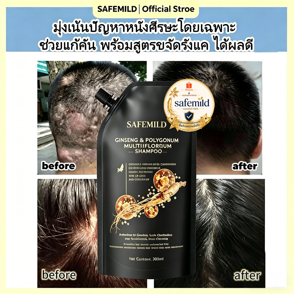 (สูตรสำหรับหนังศีรษะแพ้ง่าย) ยาสระผมสูตรอ่อนโยน 300ML ขจัดรังแค แก้คัน ลดอักเสบหนังศีรษะ ฟื้นฟูหนังศีรษะ