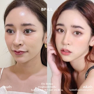 BFiLL โปรแกรม Botox Nabota โบท็อกซ์กราม ลดกราม ลิฟท์หน้า กรอบหน้าชัด ปรับรูปหน้าเรียว ออกฤทธิ์เร็ว ดื้อยาน้อย เหมา 100U