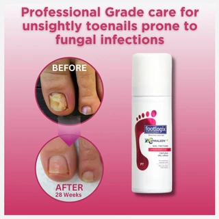 Footlogix #7T [แพ็คคู่ 2ชิ้น] สเปรย์รักษาเชื้อราเล็บ ฆ่าเชื้อรา เล็บมือ เล็บเท้า ของแท้ นำเข้าแคนาดา 50ml