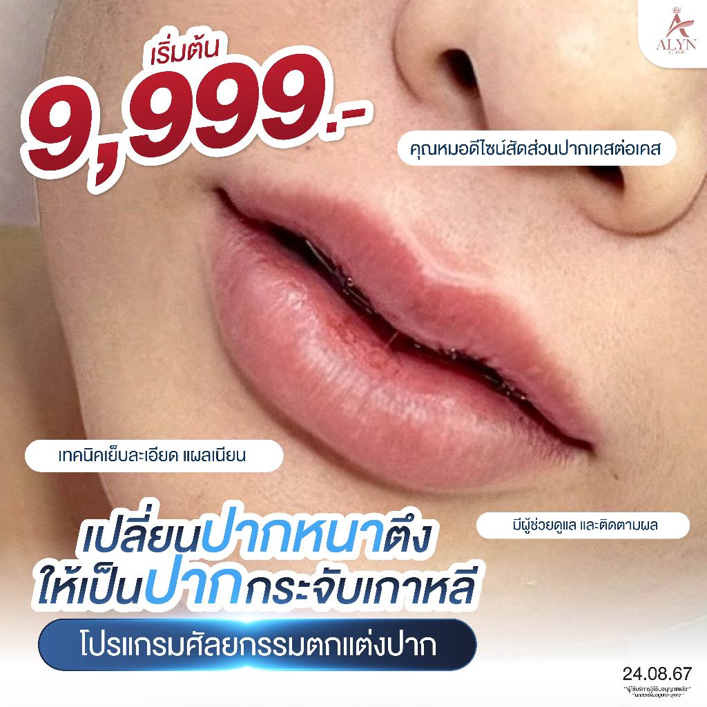 ศัลยกรรมปากทรงกระจับ ปากอวบอิ่มฉ่ำวาว เทคนิคหมอดีไซน์เฉพาะบุคคล | ALYN Clinic