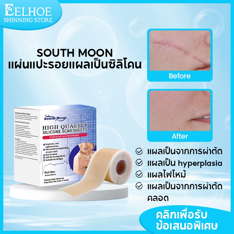 【 1 แถม 1】 แผ่นซิลิโคนปิดแผลเป็นSouth Moonแผ่นแปะซิลิโคนดูแลแผลเป็นนูน แผลเป็นคีลอยด์ แผ่นแปะลดรอย 🔥ข้อเสนอร้านค้าใหม่🔥