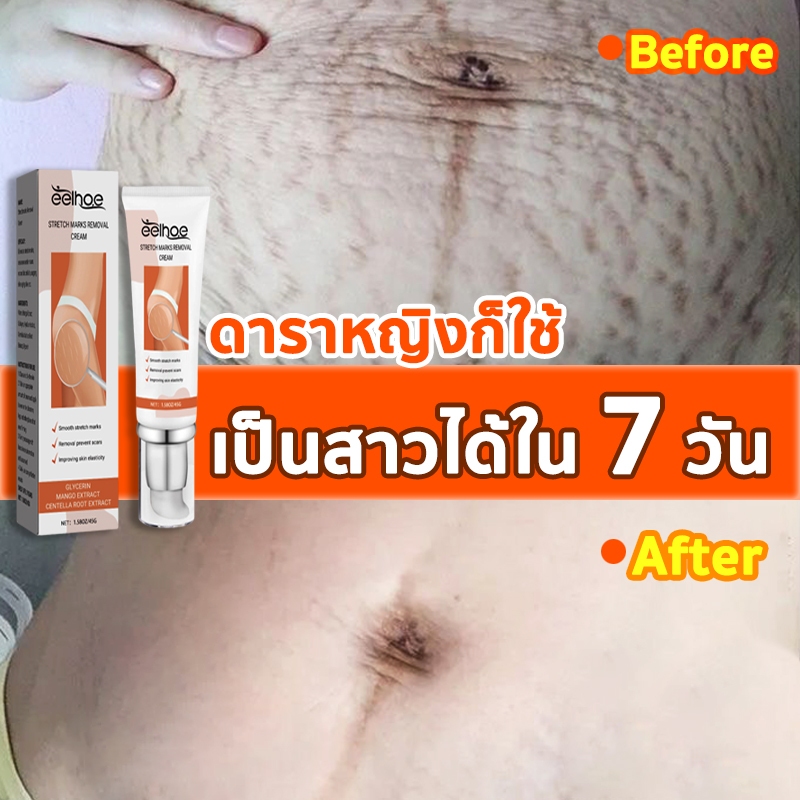 ครีมป้องกันท้องแตกลาย ลดรอยแตกลายรอยดำรอยแผลเป็น ผิวกระจ่างใสชุ่มชื้น คุณ​แม่ตั้งครรภ์ใช้ได้