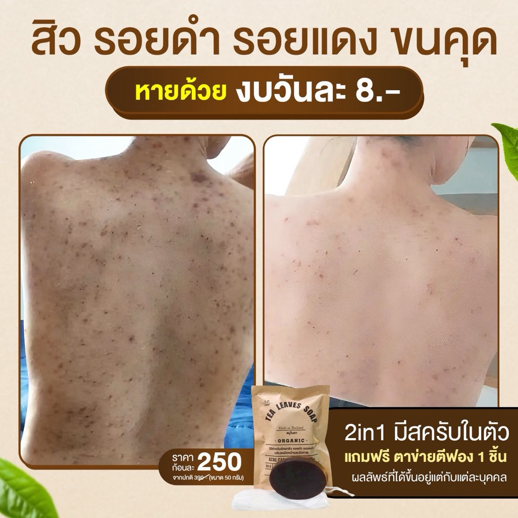 สบู่รักษาสิวที่หลัง หน้าอก ใบหน้า สูตรแพทย์แผนไทย สบู่ใบชา สบู่ใบชารักษาสิว