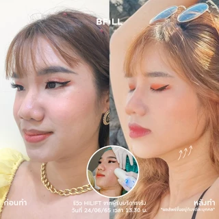 BFiLL โปรแกรม Hi Lift ไฮลิฟท์ by Specialist ลดแก้มป่อง, กรอบหน้าชัด บีฟิล คลินิก