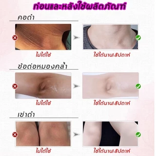 Kojic Acid ครีมขาวจุดซ่อนเร้น ครีมรักแร้ขาว ช่วยลดเม็ดสีผิวที่คล้ำตามร่างกาย ใช้ได้กับรักแร้ คอ ข้อศอก ขาหนีบ