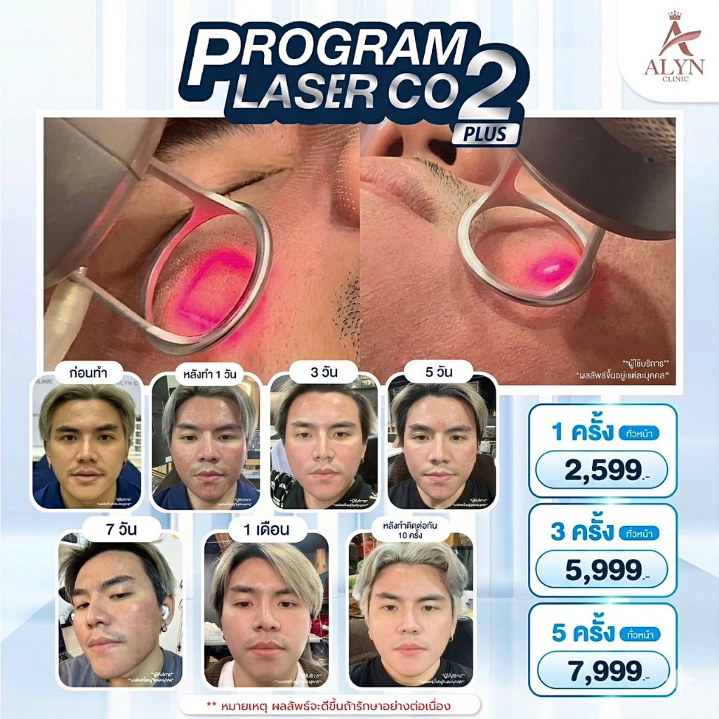 โปรแกรมเลเซอร์ CO2 Plus ทั่วหน้า รักษาหลุมสิว กระชับรูขุมขน - ALYN Clinic