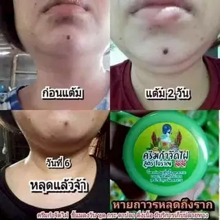 (พร้อมส่ง) ครีมกำจัดไฝ ครีมไฝ ขี้แมงวัน ตาปลา หูด ติ่งเนื้อ