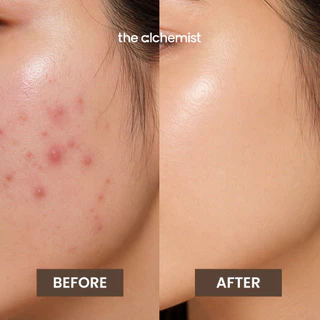 The Alchemist Acne Care & Comfort Spray สเปรย์บำรุงผิวหน้าลดสิวเกิดใหม่ ลดการสะสมแบคทีเรีย ลดหน้ามันไม่อุดตันผิว