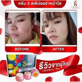 🍃✨ครีมรักษาสิว ฝ้า กระ #3สเต็ป ออร่าหน้าใส✨🍃