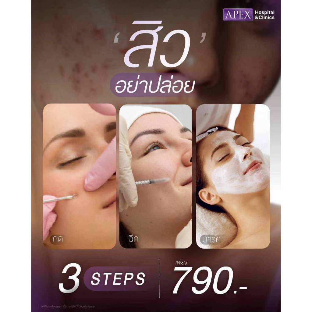 [E-Voucher] APEX โปรแกรมรักษาสิว Acne กดสิว ฉีดสิว มาร์คหน้า 3 ขั้นตอน รักษาสิวหาย พิเศษ 790 บาท