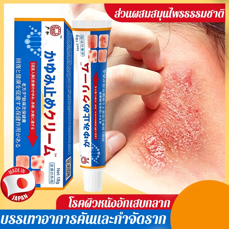 🔥ซื้อหนึ่งแถมหนึ่ง🔥ครีมแก้คัน ครีมป้องกันเชื้อร ครีมสะเก็ดเงิน เดี่ยว（18g）ทาผิวหนังอักเสบ（แบคทีเรีย）