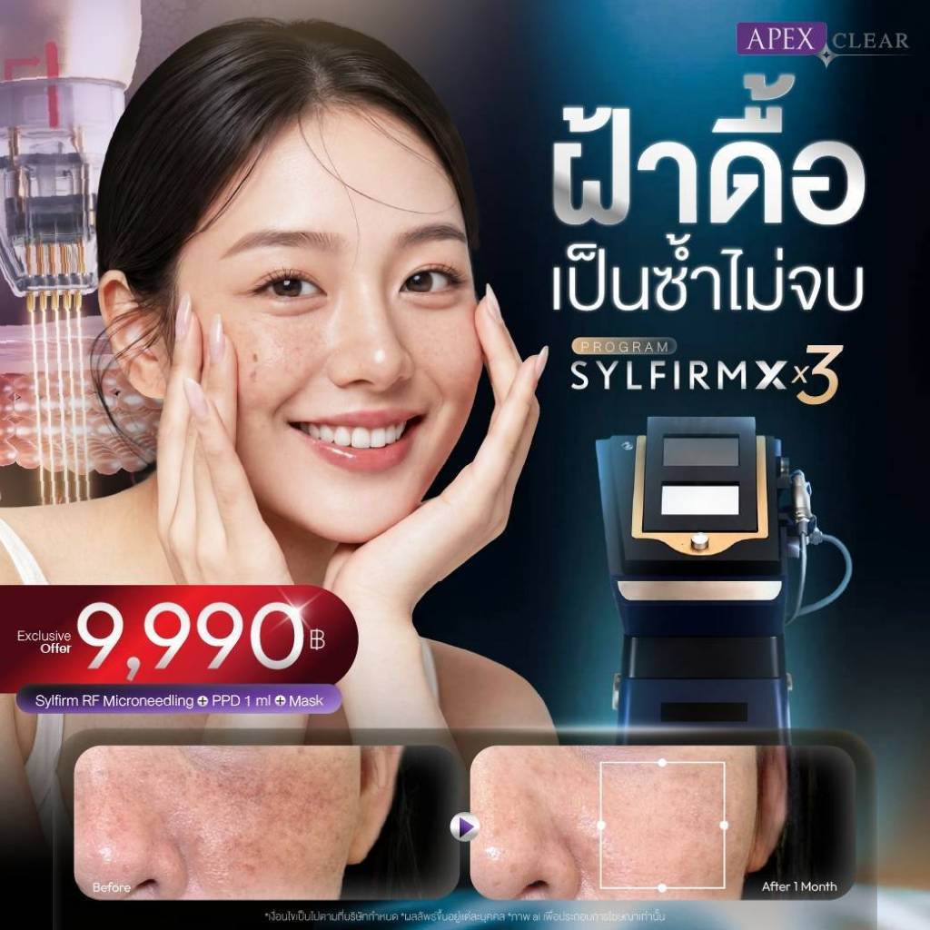 E-Voucher โปรแกรมรักษาฝ้า Sylfirm + ฉีดppdฝ้า + มาร์คผิวคอลลาเจน 3ขั้นตอน ราคาพิเศษ 9,990 บาท (1ท่าน