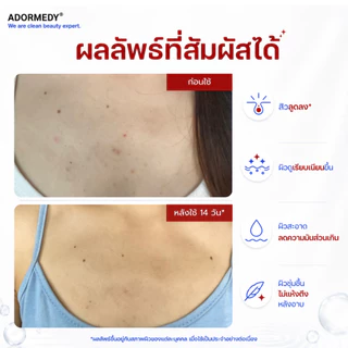 [2 ก้อน] ชาร์โคโลจี สบู่ก้อนสูตรลดสาเหตุการเกิดสิว Charcoalogy Acne Clearing Face and Body Clay Soap