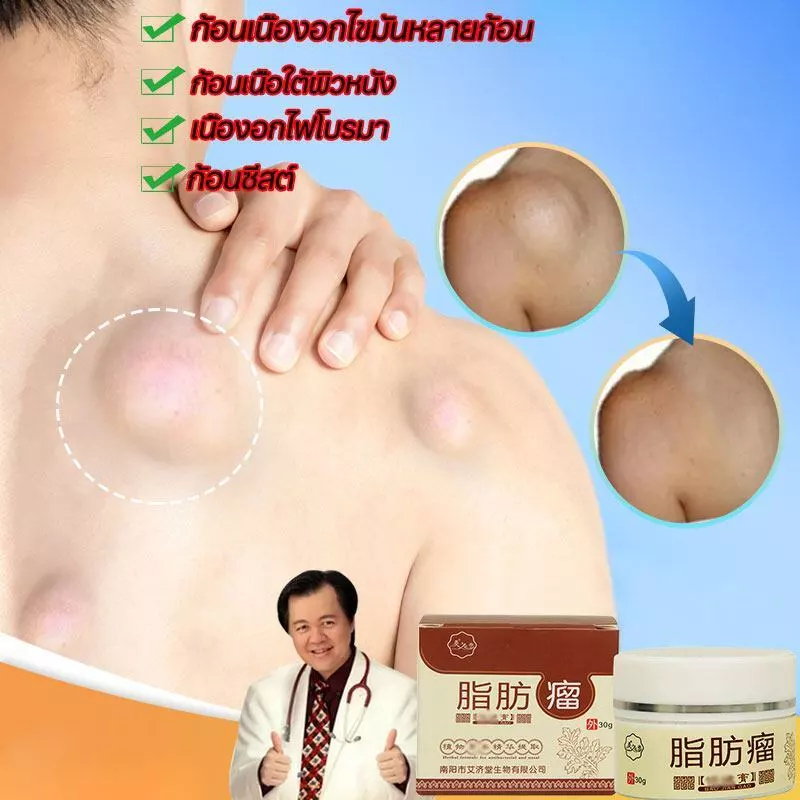 ครีมทาก้อนเนื้องอกไขมัน ครีมกำจัดก้อนซีส กำจัดเม็ดไขมัน 30g กำจัดก้อนไขมันใต้ผิวหนังอย่างปลอดภัยไม่เจ็บ