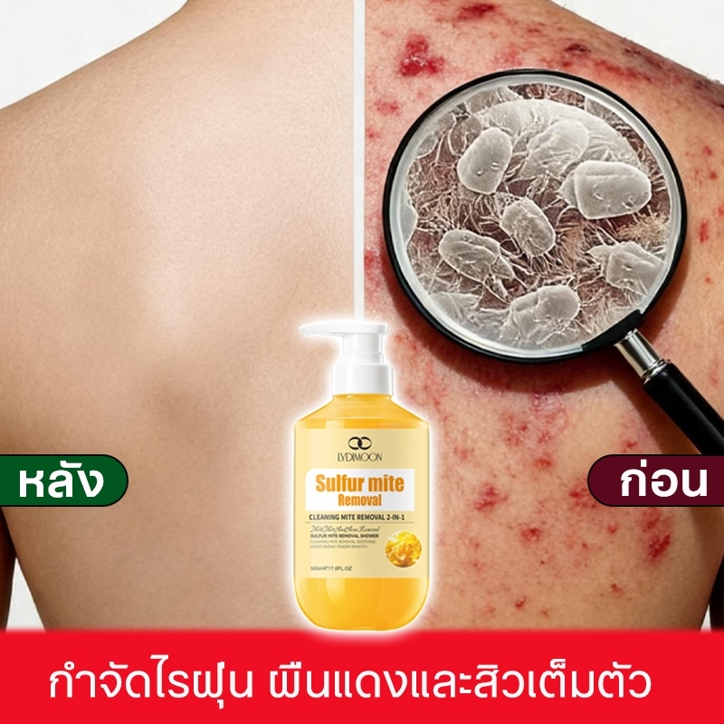 เจลอาบน้ำฆ่าเชื้อขนาด 500 มิลลิลิตร เจลอาบน้ำน้ำซัลเฟอร์ ใช้เพื่อลดสิวและอาการคัน ลดจุดด่างดำ ผื่น และสิวบนหลังและหน้าอก
