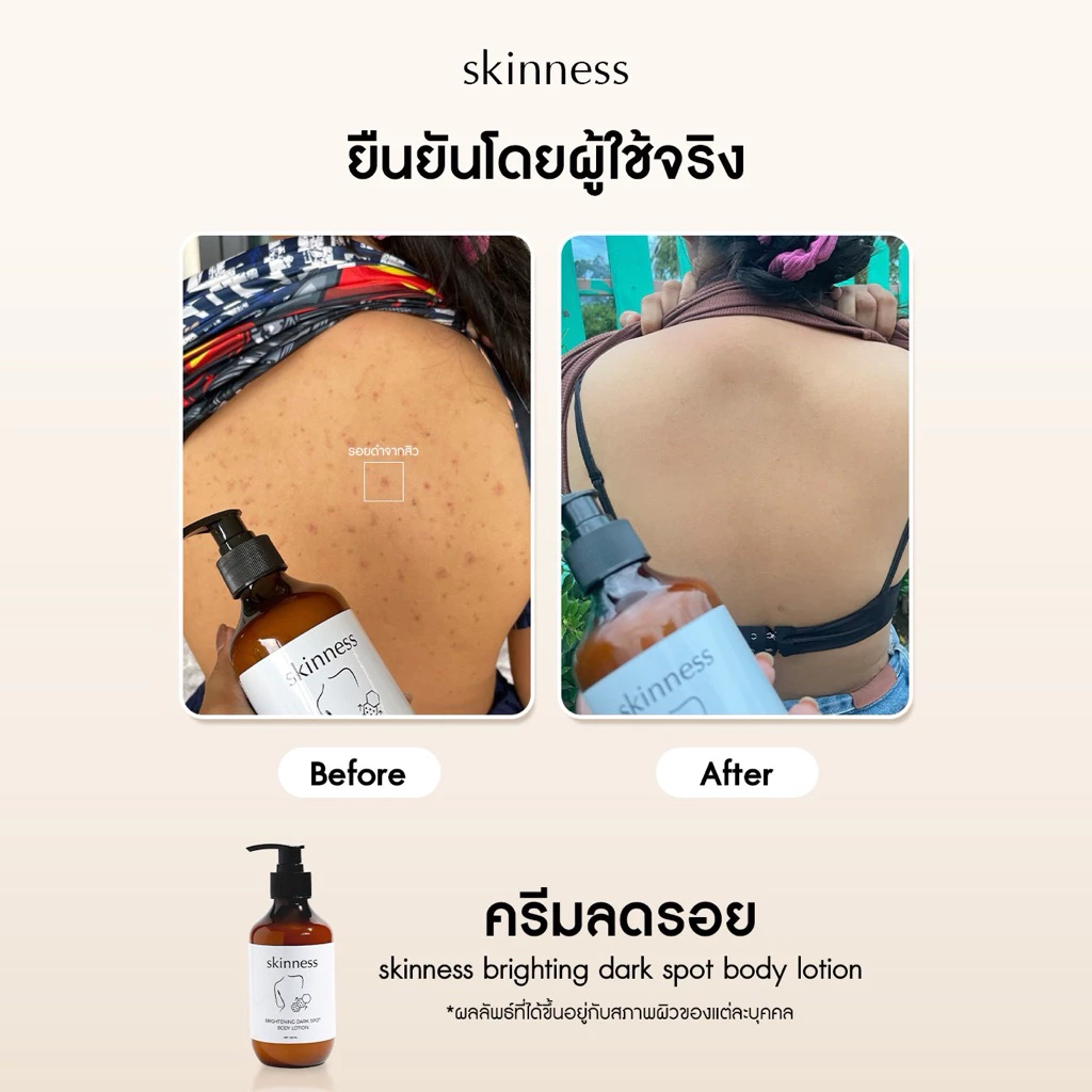 Skinness Brightening Dark Spot Body Lotion ครีมลดรอยบำรุงผิวกาย thumbnail 8
