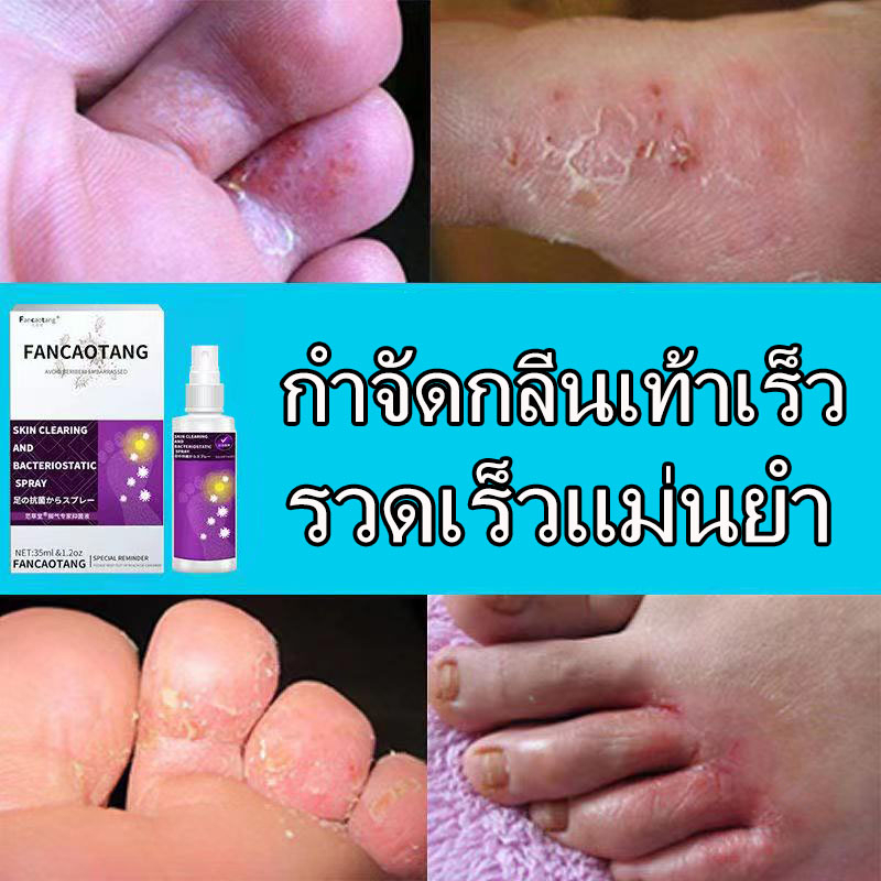 ถ้ารักษาไยไม่คิดเงิน☞ครีมลดเท้า ครีมทาเท้า ช่วยบรรเทาปัญหาเท้าลอกและมีกลิ่นได้อย่างรวดเร็ว ดับกลิ่นเท้าสเปย์ด - รูปที่ 2