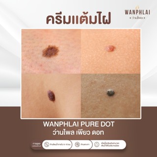 ครีมแต้มไฝ ว่านไพล ขี้แมลงวัน ติ่งเนื้อ หูด ตาปลา แก้ปัญหา ส…