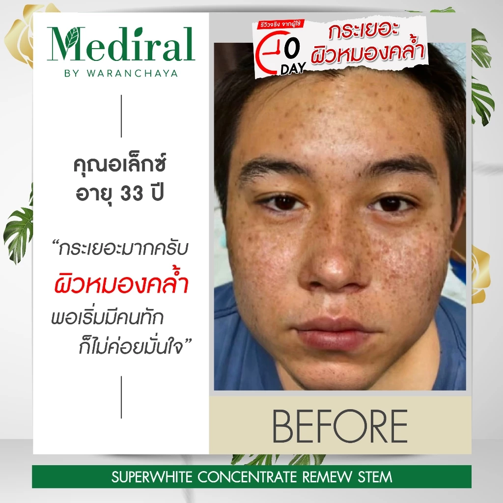 (ส่งฟรี) เซรั่มลดสิว+เซรั่มหน้าใส ลดรอยสิว ฝ้า กระ สกินแคร์ออร์แกนิกใช้คู่กันลดสิวผิวใส thumbnail 9
