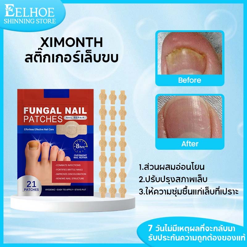 Ximonth สติ๊กเกอร์เล็บขบ แผ่นแปะดูแลเล็บเท้า เพื่อรักษาเชื้อรา เสริมความแข็งแรงปกป้องเล็บเปราะ