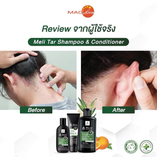 แชมพูขจัดรังแค ใหม่ สูตรเข้มข้น MELI TAR SHAMPOO ลดรังแค ชันนะตุ สะเก็ดเงิน อาบน้ำได้