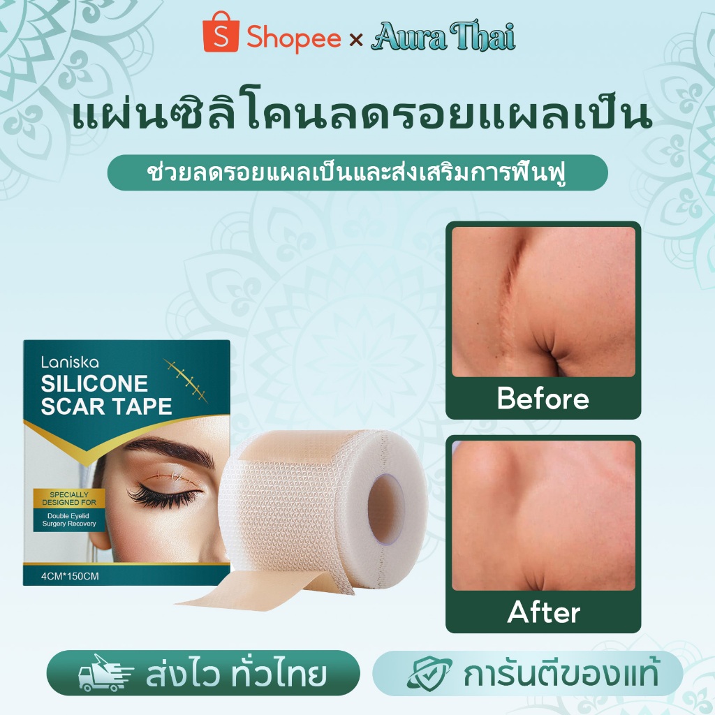 【1แถม1】แผ่นแปะซิลิโคน ซิลิโคนลดรอยแผลเป็น แผ่นแปะแผลเป็น Laniska 4x150 ซม. ลดรอยแผลเป็น รอยแผลผ่าตัด​