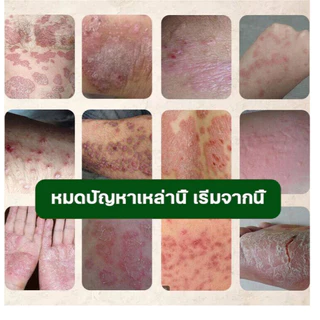 ครีมแก้คันผิว ลดผื่นคัน บรรเทาอาการคัน ฆ่าเชื้อรา ฟื้นฟูผิว เห็นผลไว 20G