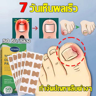 Jaysuing แผ่นแปะเล็บขบ แผ่นปรับรูปเล็บนิ้วเท้า สติกเกอร์แก้ไขเล็บเท้า แผ่นแปะเล็บคุด เล็บขบ ซ่อมเล็บ