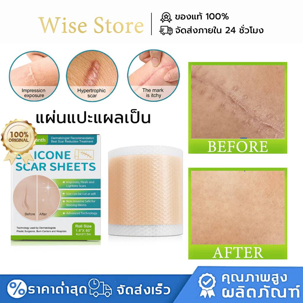 West&Month รักษารอยแผลเป็น แผ่นแปะแผลเป็น กําจัดรอยแผลเป็นจากแผลเป็น เผยผิวเนียนสวย silicone scar sheet 4cm*150cm