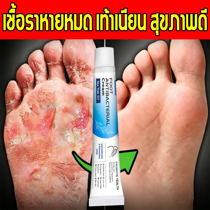 ครีมทาเท้า รักษาเชื้อราที่เท้า บรรเทาอาการคัน ความแห้ง ผิวลอก ตุ่มน้ำ ส่วนผสมอ่อนโยน ใช้งานง่าย ลดกลิ่นเท้า