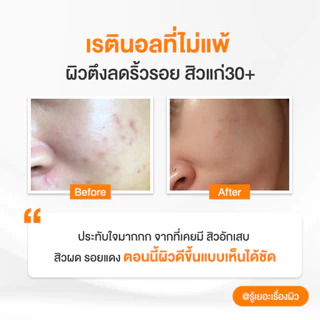 เรตินอล ที่ไม่แพ้ อ่อนโยน สูตร เคลียร์สิว คุมมัน 4 in 1 Natural Retinol Moisturizer สูตร Anti-Acne 45 ml.