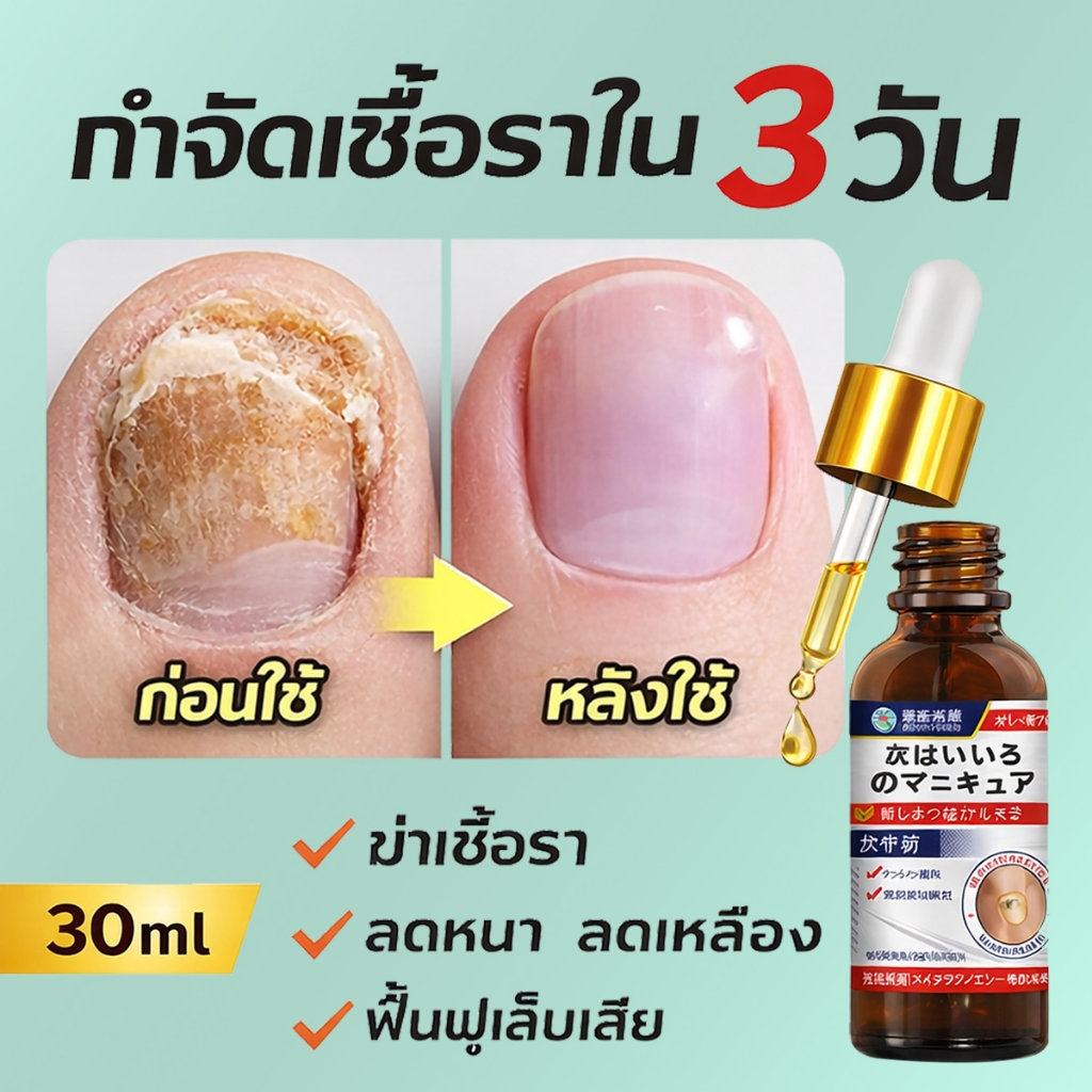 【บอกลาเชื้อราที่เล็บเท้า】รักษารคเชื้อราที่เล็บ เล็บพัง เล็บขบ เซรั่มบำรุงเล็บ น้ำมันบำรุงเล็บ ยาฆ่าเชื้อราที่เล็บ