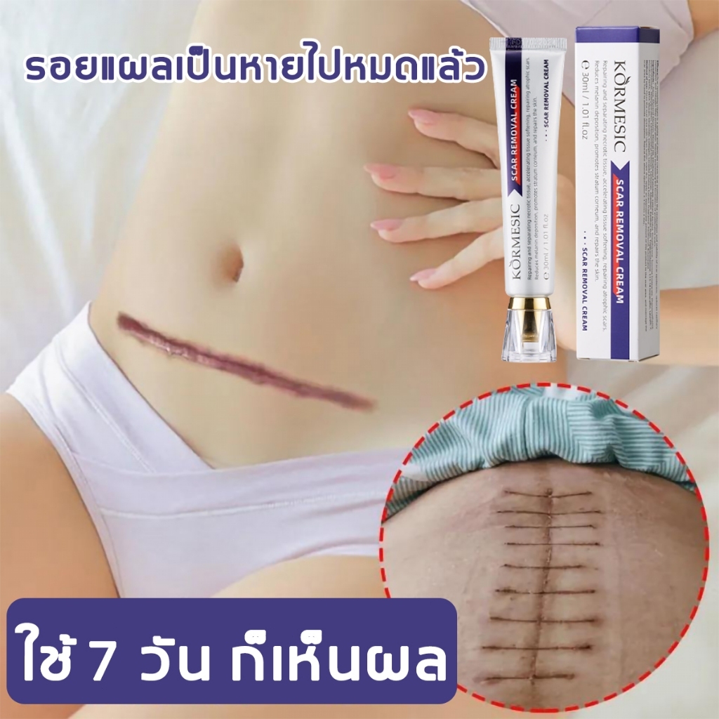 ครีมลบรอยแผลเป็นสีดำ 30ก ทาได้กับแผลไฟไหม้ รอยแตกลาย ลดรอยให้จางลงคงทน