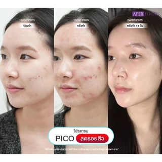 [E-Voucher] APEX โปรแกรม Pico New Gen ราย1ครั้ง ลดรอยสิว รอยแดง รอยดำ หลุมสิวหาย หน้าใส สำหรับลูกค้าใหม่ / ไม่เคยทำพิโค่