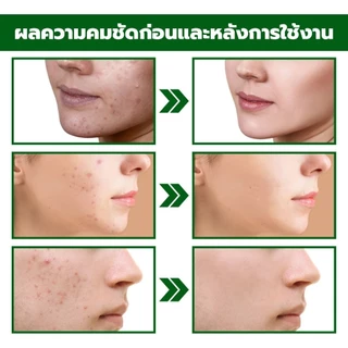เซรั่มลดสิว 30ml ครีมเจลแต้มรักษาสิว กำจัดสิว ลดรอยสิว ทำรอยสิวจางลง