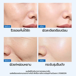 【COD】LYDIMOON แผ่นแปะ แผ่นแปะหน้าผาก hyaluronic acid คอลลาเจน มอยเจอไรเซอร์ ยกกระชับใบหน้า ลดริ้วรอย ผิวเรียบเนียน
