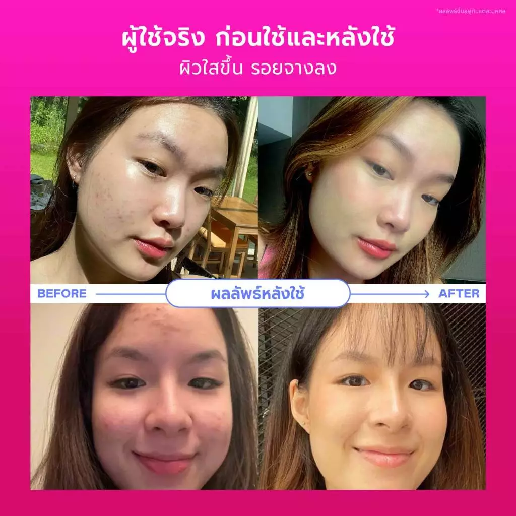 DIVYNE Skincare Birthday Promotion Set | เซตผิว โปรโมชั่นวันเกิด มาส์ก สำหรับสิว รูขุมขน thumbnail 8