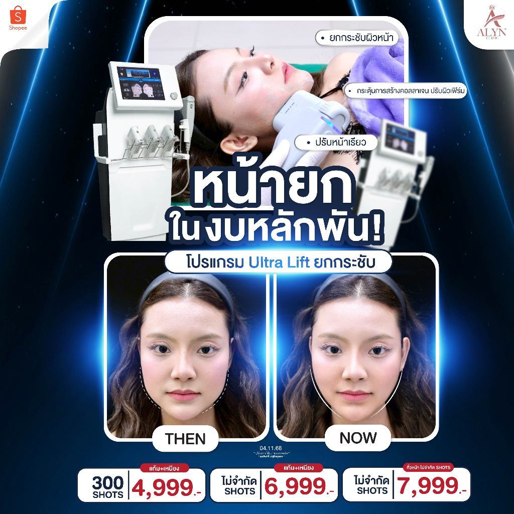 Ultra Lift โปรยกกระชับผิวหน้า ปรับหน้าเรียว กรอบหน้าชัด - ALYN Clinic