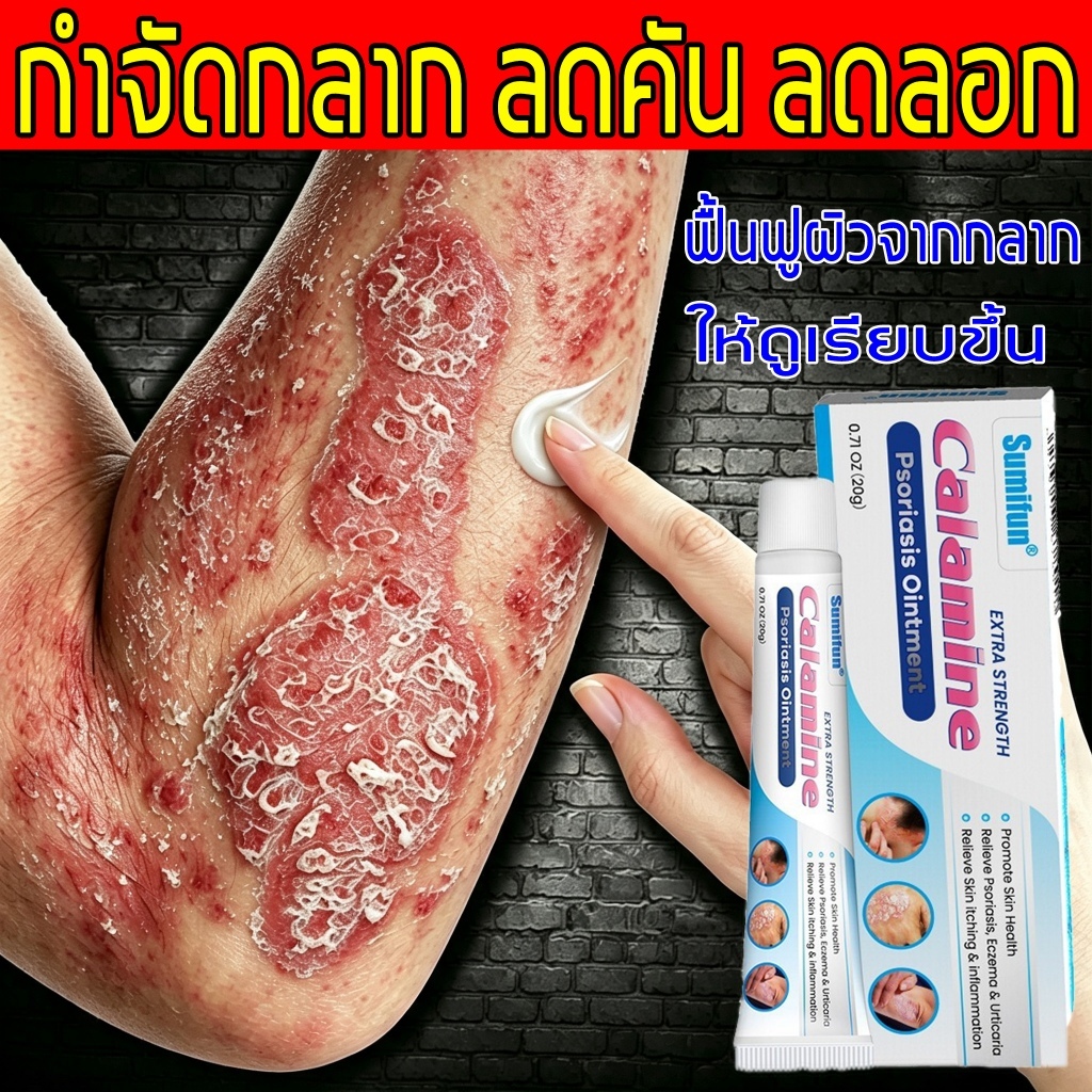 ครีมแก้คัน ครีมสะเก็ดเงิน ดูแลโรคผิวหนัง กลาก เกลื้อน อาการคัน คันเรื้อรัง ช่วยลดผื่นแดงและการลอก ฟื้นฟูผิวที่เสียหาย