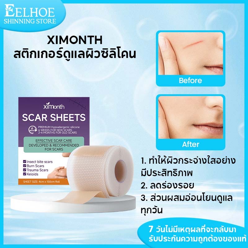 Ximonth แผ่นแปะแผลเป็น แผ่นแปะซิลิโคน แผ่นแปะลดรอยแผลเป็นนูน รักษารอยแผลเป็น